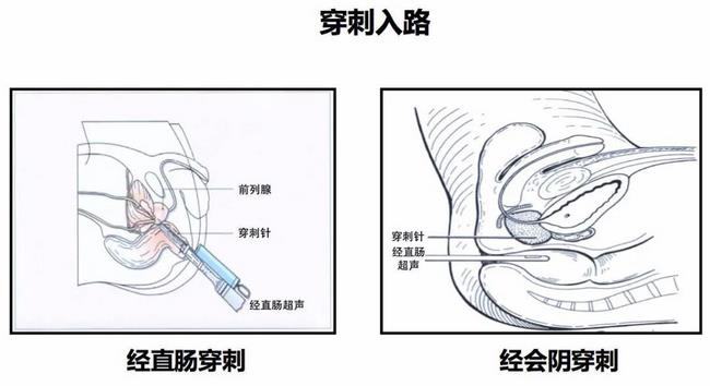 云顶集团yd1233检测网址首次开展超声引导下经会阴前列腺穿刺(图1)