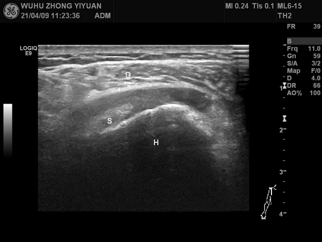 【新技术】我院功能1科开展肌骨超声新技术(图2)