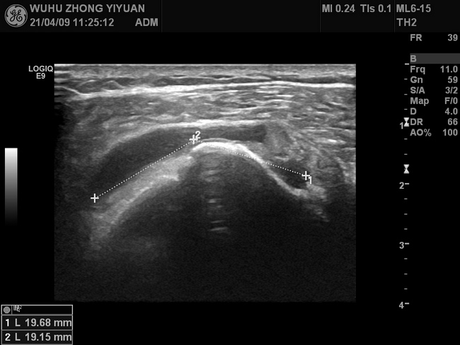 【新技术】我院功能1科开展肌骨超声新技术(图3)