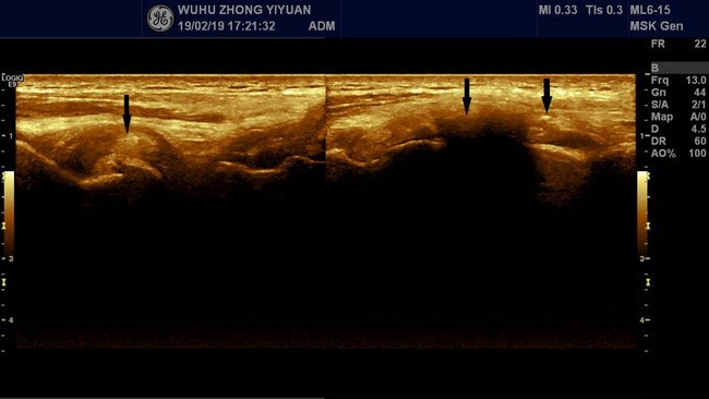 【新技术】我院功能1科开展肌骨超声新技术(图6)