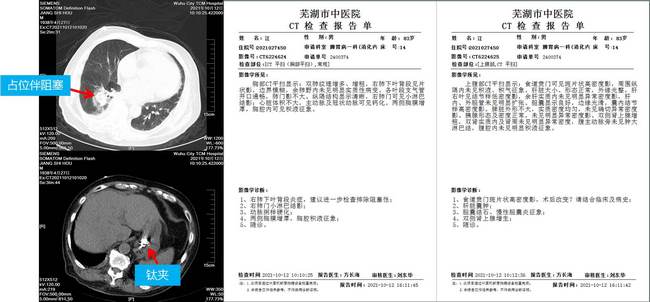 小钛夹，威力大 ——记一例上消化道大出血患者的救治经过(图2)