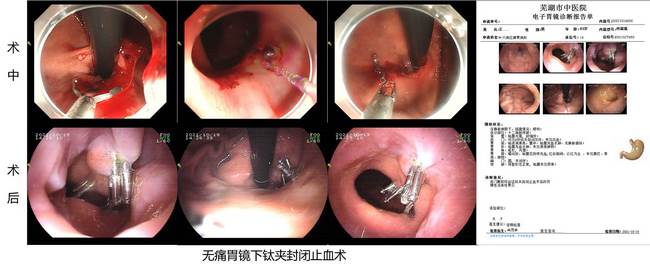 小钛夹，威力大 ——记一例上消化道大出血患者的救治经过(图4)