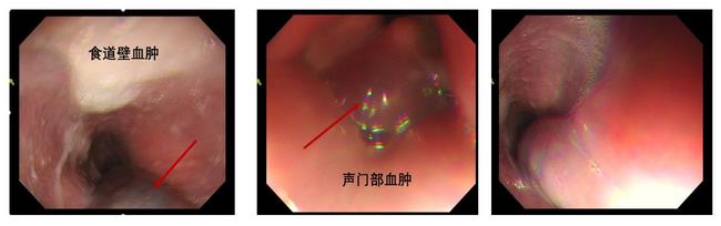 小异物，大后果 ——一个消化科医生的日记(图1)