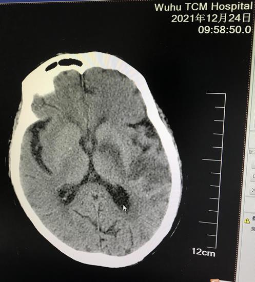 我院卒中中心救治团队成功为一例高龄重症脑卒中 患者行脑血管介入取栓手术(图4)