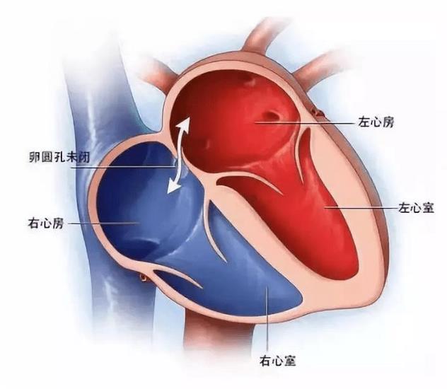 探寻不明原因卒中、偏头痛根源的检查技术—TCD发泡试验(图1)