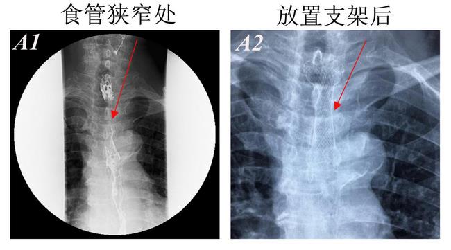 消化科运用多学科会诊（MDT）微创诊治食管恶性肿瘤侵润所致食、气道梗阻(图4)