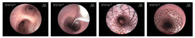 消化科运用多学科会诊（MDT）微创诊治食管恶性肿瘤侵润所致食、气道梗阻(图6)