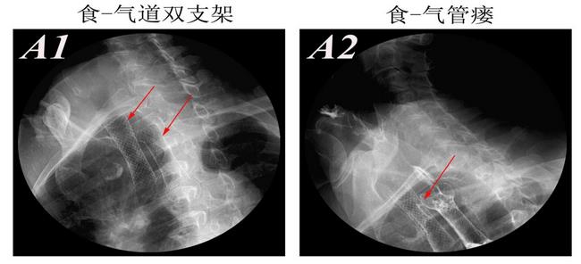 消化科运用多学科会诊（MDT）微创诊治食管恶性肿瘤侵润所致食、气道梗阻(图8)