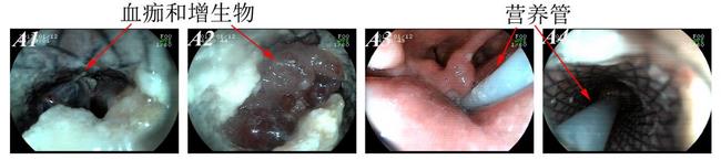 消化科运用多学科会诊（MDT）微创诊治食管恶性肿瘤侵润所致食、气道梗阻(图9)
