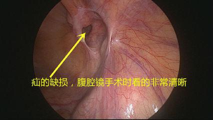 切口小，当天即可生活自理——外三科开展腹腔镜下疝气手术(图1)