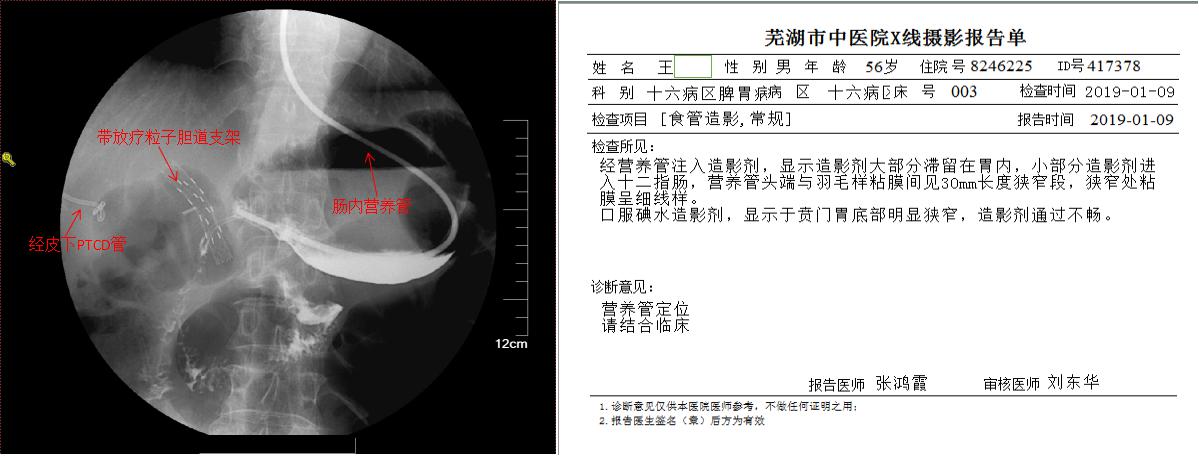 三个支架植入后——我院脾胃病1科成功为肿瘤患者施行内镜下高难度多支架植入术(图2)