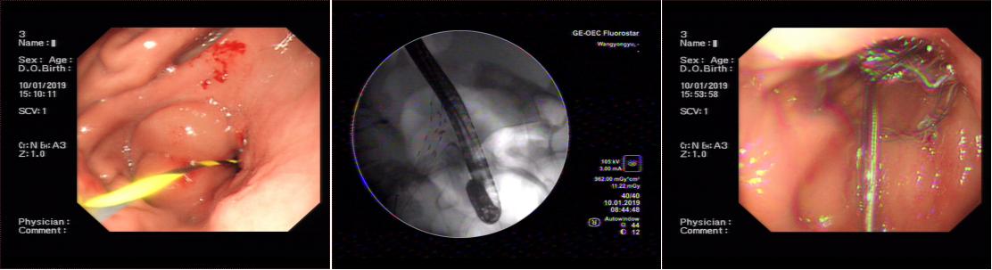 三个支架植入后——我院脾胃病1科成功为肿瘤患者施行内镜下高难度多支架植入术(图3)