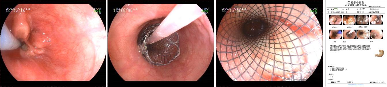 三个支架植入后——我院脾胃病1科成功为肿瘤患者施行内镜下高难度多支架植入术(图5)