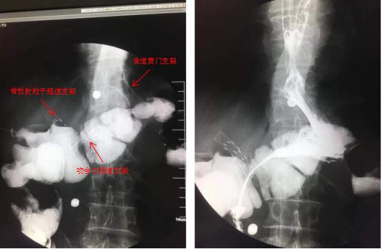 三个支架植入后——我院脾胃病1科成功为肿瘤患者施行内镜下高难度多支架植入术(图6)