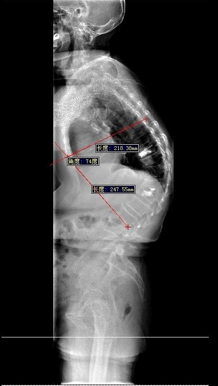 不忘医者初心——骨四科成功开展高难度脊柱侧弯矫形手术(图1)