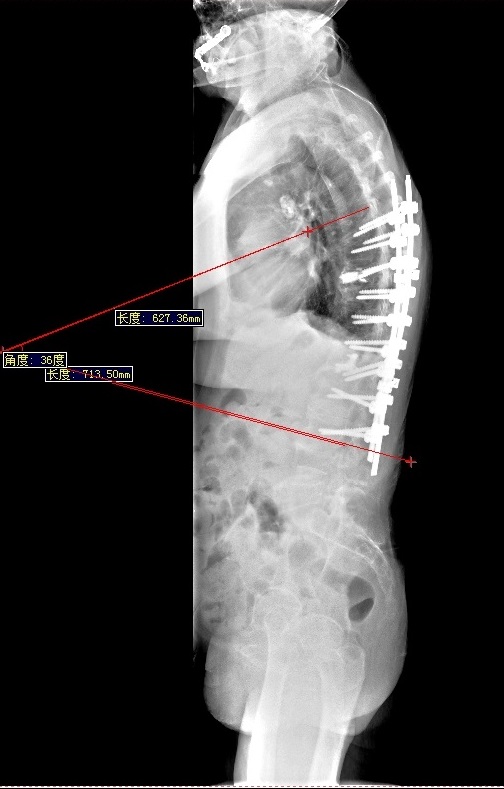 不忘医者初心——骨四科成功开展高难度脊柱侧弯矫形手术(图3)