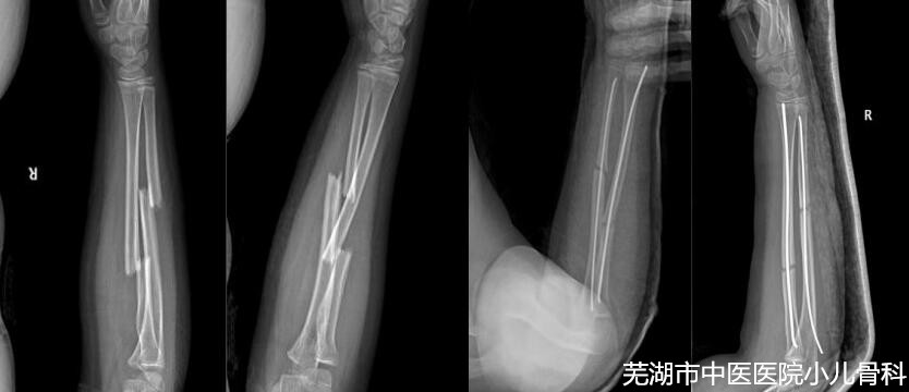 儿童健康的守护者——云顶集团yd1233检测网址儿童骨科(图3)