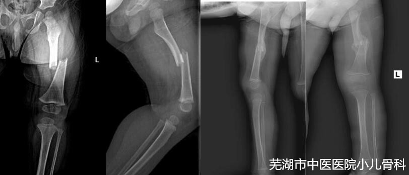 儿童健康的守护者——云顶集团yd1233检测网址儿童骨科(图7)